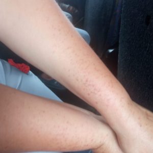 Alergia por picaduras en los brazos de la esposa de Eduardo